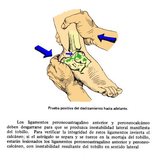 ENTORSE DO LIGAMENTO LATERAL EXTERNO A - FISIOPATOLOGIA E DIAGNÓSTICO: Pode haver três tipos de entorses, do ponto de vista médico.