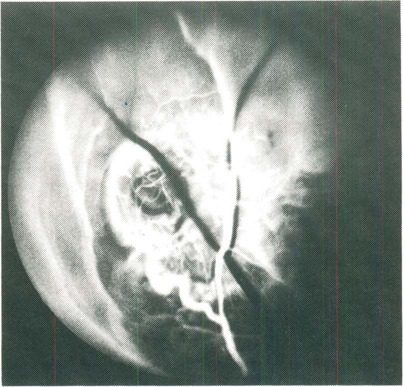 casos da série e sempre em tumores com mais de 6 mm de altura. FISHMAN3, em 1977, baseado nas observações de EOWARDS postulou que o aparecimento da dupla circulação Ig.