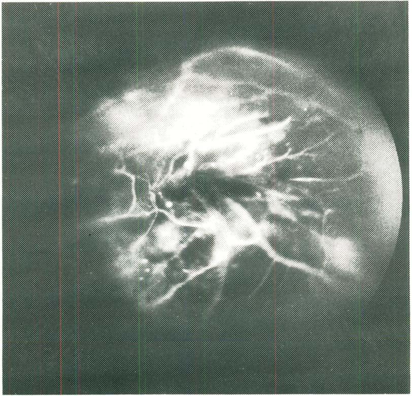 Fig. 3 - Estudo angiofluoresceinográfico mostrando a duola circulação num melanom;t de coróide de grande tamanho e tamhém a presença de uma anastomose retino-tumoral.
