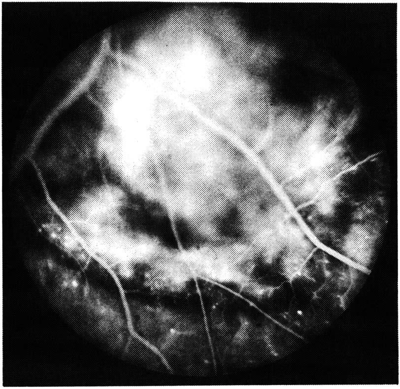 Fig. 7- Esquerda - Fase tardia de estudo angiogluoresceinográfico num melanoma de coróide de grande tamanho onde se observam pequenos pontos hiperfluorescentes na margem tumoral e hiperfluorescencia