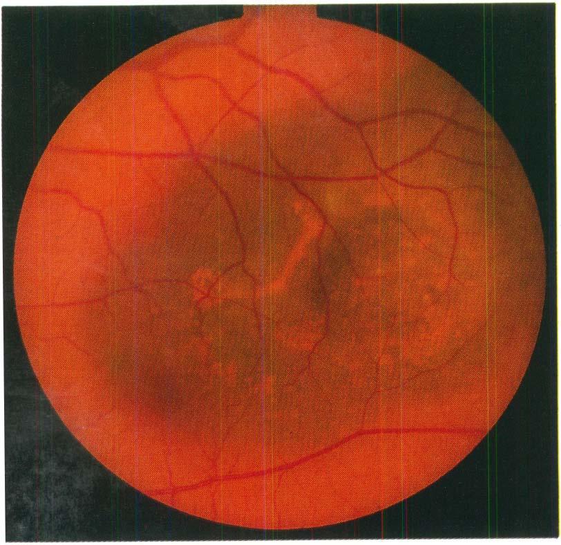 Fig. 8 - Melanoma de coróide de tamanho médio. Este caso foi enucleado após ter sido documentado fotográfica e angiograficamente crescimento do tumor.