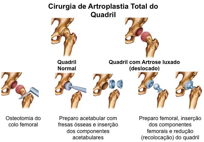 Artroplastia Total de Quadril é um procedimento ortopédico que envolve a retirada cirúrgica da cabeça e porção proximal do colo do fêmur e remoção da cartilagem acetabular e osso acetabular