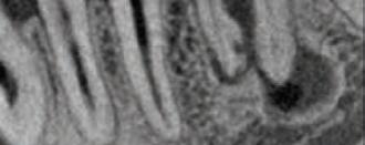 No campo de 5xØ5cm (6x4cm), existe também uma resolução Endo para radiografias de alta precisão das estruturas do canal radicular e periodontia.