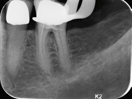 As imagens intraorais claras e nítidas do KaVo Scan exam One reproduzem níveis de cinza com precisão para