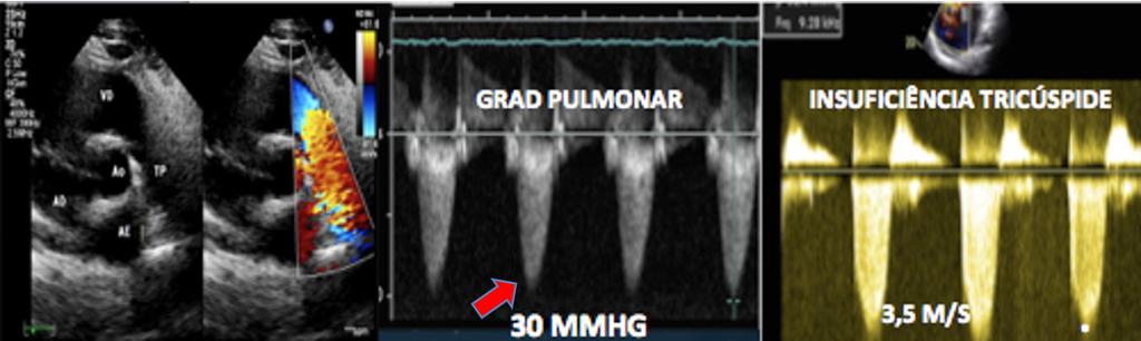 QUESTÃO 26 Considere que um paciente de 25 anos de idade com estenose valvar pulmonar, realizou ecocardiograma transtorácico, que evidenciou a situação apresentada nas imagens a seguir.