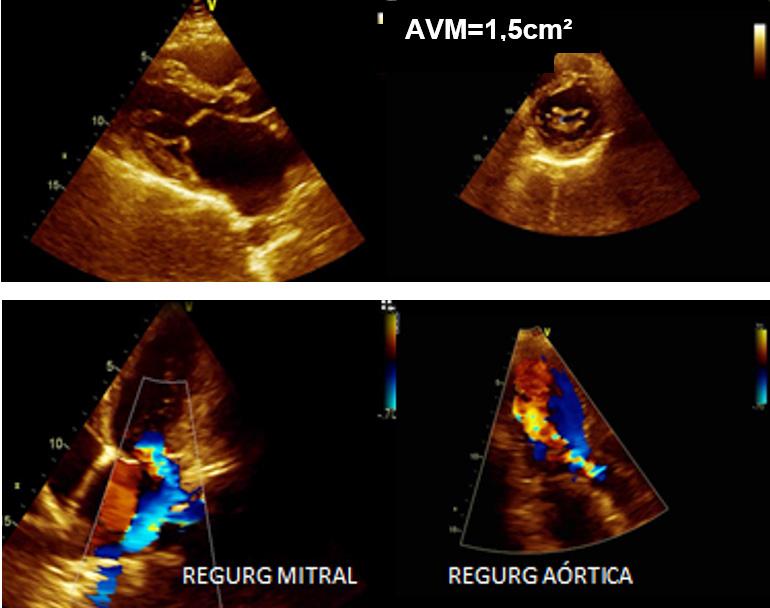 ventricular direita. B) A pressão sistólica arterial pulmonar é de 34 mmhg. C) A pressão sistólica ventricular direita é 45 mmhg maior que a pressão sistólica máxima da artéria pulmonar.