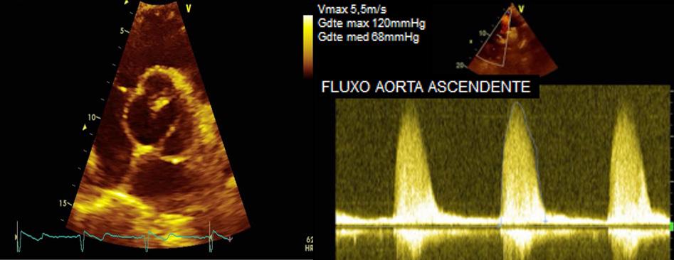 A) 1. Aorta. B) 2. Veia pulmonar. C) 3. Átrio esquerdo. D) 4. Veia cava superior. E) 5. Ramo esquerdo da artéria pulmonar.