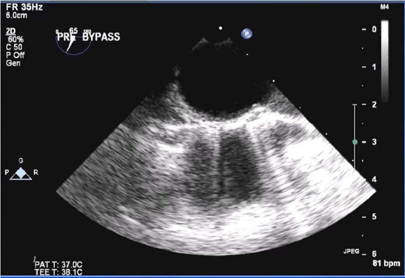 QUESTÃO 37 Um ecocardiograma transesofágico, durante a cirurgia de revascularização do miocárdio e plastia mitral, com o paciente em condições hemodinâmicas estáveis, apresentou a imagem a seguir.