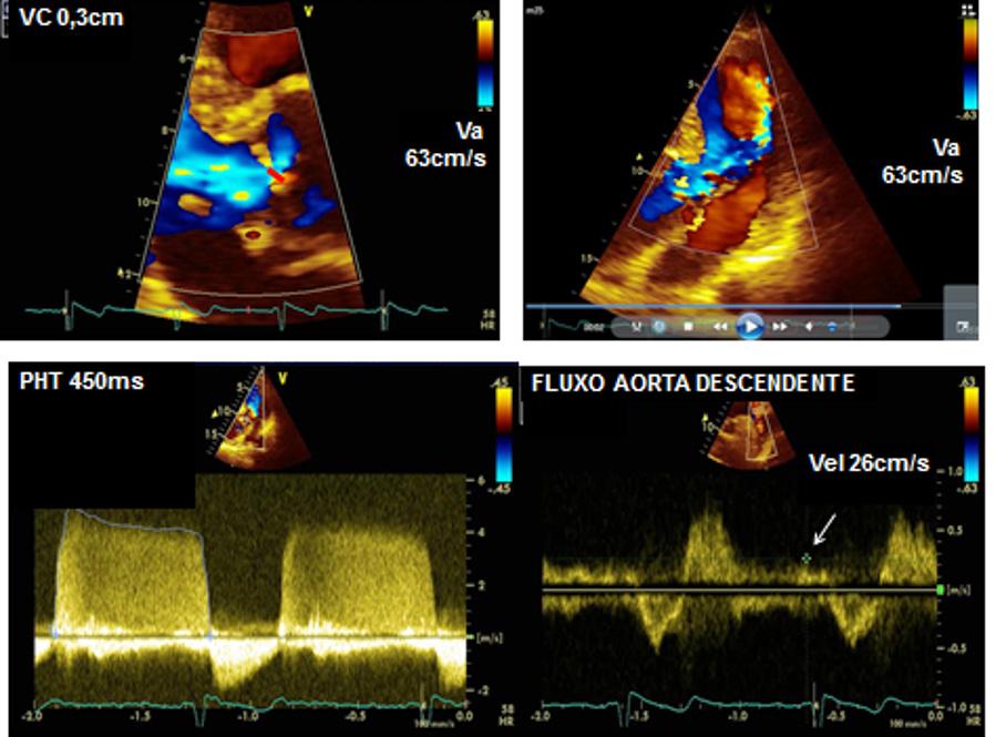 QUESTÃO 43 Analise o caso clínico a seguir. Paciente do sexo masculino, 65 anos de idade, assintomático cardiovascular, é encaminhado para avaliação ecocardiográfica de regurgitação aórtica.