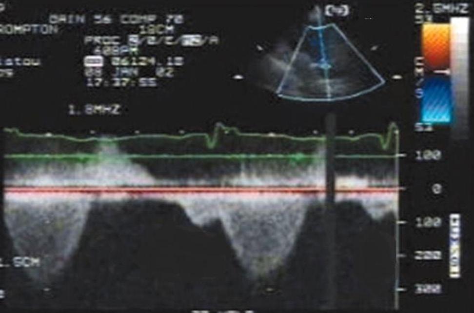 QUESTÃO 49 Considere que um paciente de 28 anos de idade, em pós-operatório tardio de correção total de tetralogia de Fallot com interposição de monocúspide em posição pulmonar, vem ao hospital com