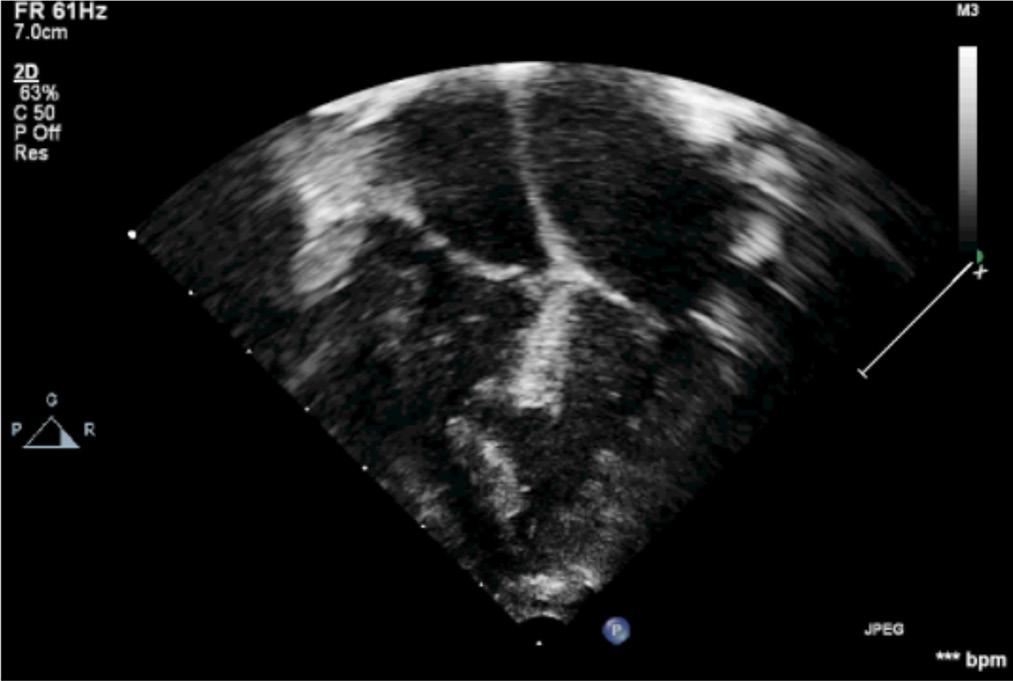 QUESTÃO 50 Considere que um paciente de 3 anos de idade, evoluindo com taquipneia, baixo ganho ponderal e sopro sistólico em borda esternal esquerda à ausculta, apresenta estas imagens ao