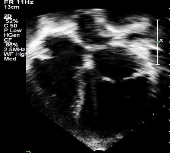 QUESTÃO 60 De acordo com as imagens a seguir, assinale a alternativa que apresenta o diagnóstico da cardiopatia congênita representada.