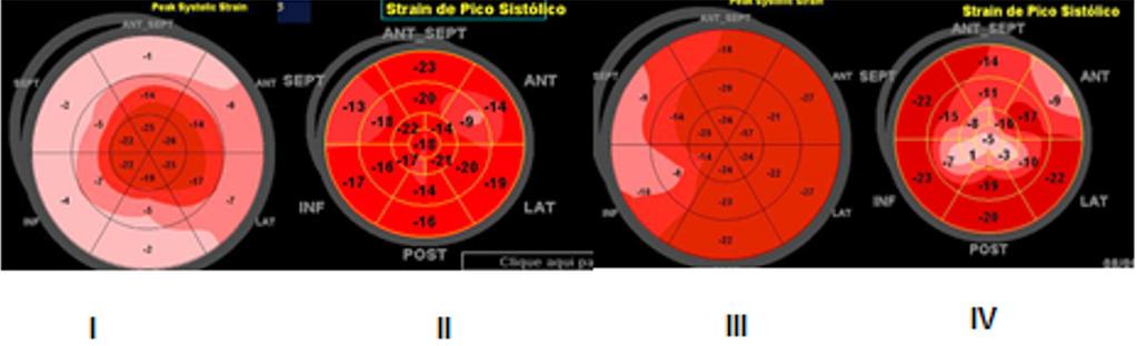 QUESTÃO 67 Considerando os padrões pelo bull s eye de strain longitudinal em pacientes que apresentam a mesma espessura da parede ventricular esquerda de 14 mm, I, II, III e IV são, respectivamente: