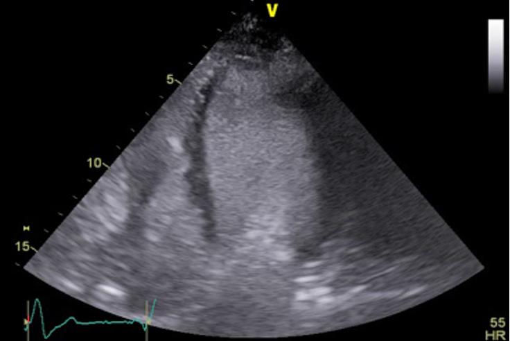 B) I: Cardiomiopatia hipertrófica, forma apical; II: Cardiomiopatia hipertrófica; III: Amiloidose; IV: Hipertrofia concêntrica da hipertensão arterial sistêmica.