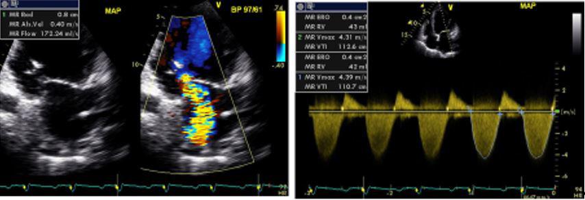 QUESTÃO 14 Paciente transplantado cardíaco há 5 meses foi submetido a biopsia endomiocárdica de rotina. Ecocardiograma foi realizado logo após a biópsia.