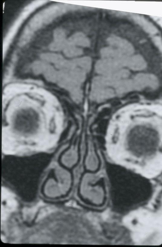 CORONAL