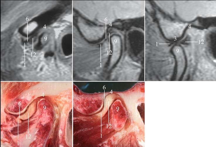MRI and autopsy sections: upper row oblique sagittal MRI,