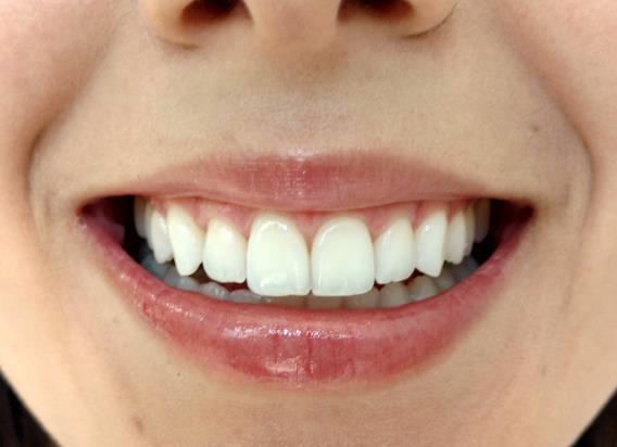 A progressão do sorriso permite que os lábios se separem e os cantos da boca se curvam para cima, de maneira a expor os dentes (6).