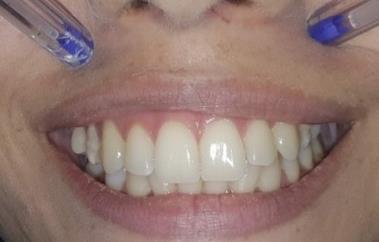 Assim, a aplicação da toxina da botulínica é uma alternativa adicional na melhoria do sorriso e oferece melhores resultados se combinados com cirurgia gengival ressectiva (21).