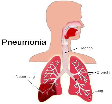 PNEUMONIA