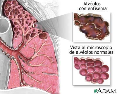 Alvéolos com