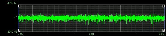 Finsterer J. EMG-interference pattern analysis. J Electromyogr Kinesiol.