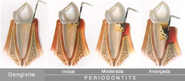 Periodontia: tratamento da