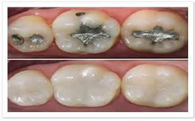 Dentística: São as restaurações