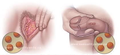 Câncer de colo do útero (CCU) Quase todos os casos de CCU são causados pelo HPV (vírus do papiloma humano); O HPV é um vírus comum transmitido nas relações sexuais; Existem