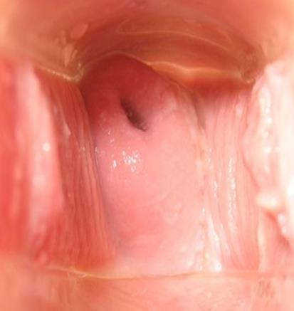 Colo uterino normal Fio do DIU Tem aspecto róseo com superfície lisa; A superfície do
