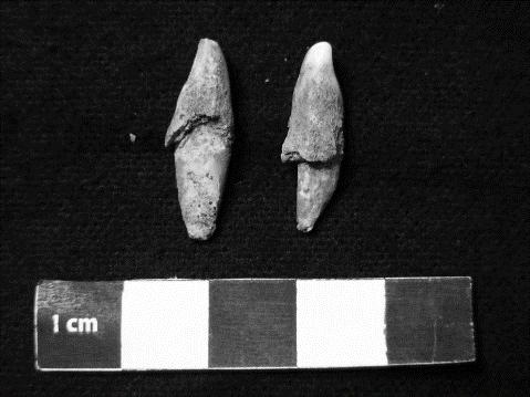 Figura 22 - Hipoplasias do esmalte dentário 5.