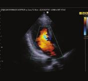 Em Modo Doppler Espectral Pulsado, QuickScan TM otimiza o espectro ao ajustar a escala e a linha de base automaticamente.