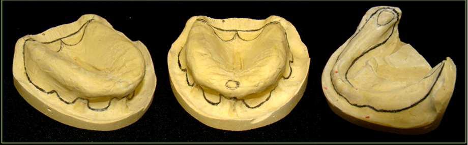 72 72 Material e Método 3.2.3.2. Técnica Simplificada As diferenças propostas para a técnica simplificada foram: (A) Exclusão da etapa laboratorial de confecção de moldeira individual e da etapa clínica de moldagem funcional.