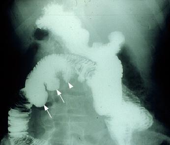 A dilatação das ansas intestinais é a característica radiográfica mais proeminente quando a ausência de peristálise afecta o ID sinal típico de mola ( wire-spring ) produzido por Ilustração 22