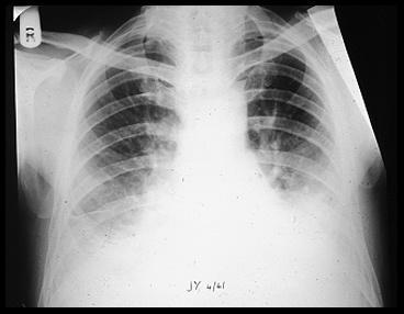 Os testes de função pulmonar com espirometria, a medição dos volumes pulmonares e capacidade de difusão de monóxido de carbono (DLCO) são o melhor método de rastreio da DPI.