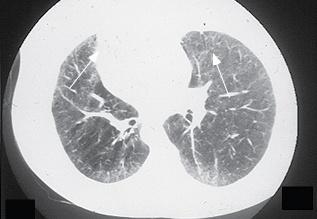 do que com a forma limitada. (92) O TAC AR pode revelar opacidades em vidro despolido sugestivas de inflamação da parede alveolar e/ou padrão reticulo-nodular sugestivo de doença pulmonar fibrótica.