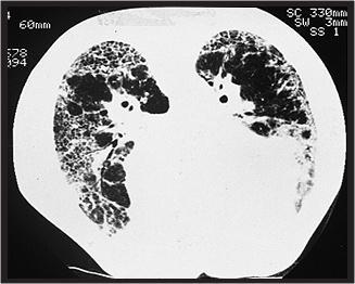 Tal é especialmente preponderante na ESD e nos pacientes com doença pulmonar mais extensa. (92) Ilustração 25 TAC AR num paciente com ES e alveolite.