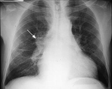 da doença afecta já 50% do lobo pulmonar. O LBA é anormal em 64 a 85% dos pacientes com ES e tem valor prognóstico demonstrado.