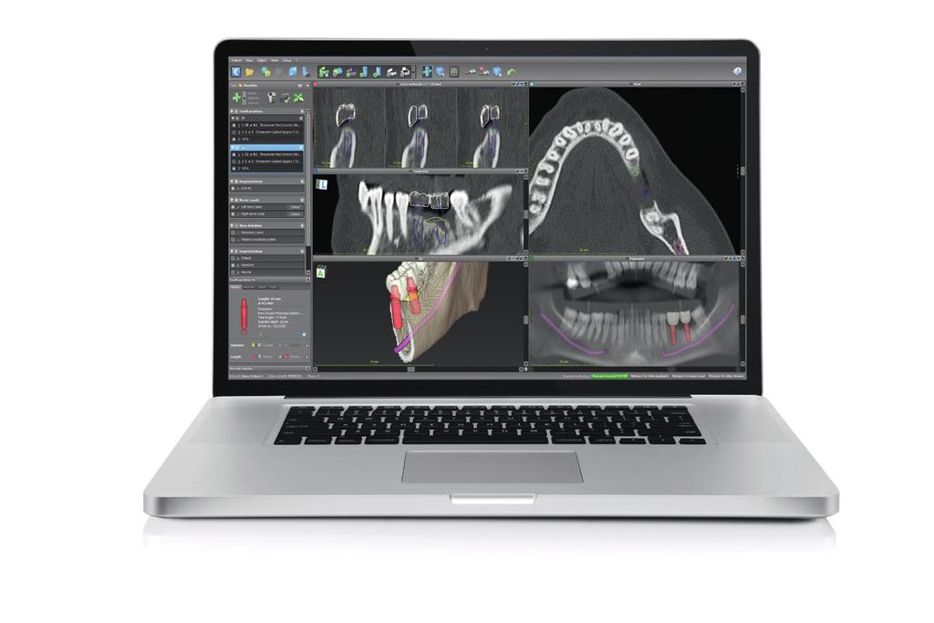 Planeamento pré-operatório Também existe a possibilidade de se proceder ao planeamento digital com o codiagnostix Este software de diagnóstico 3D e planeamento de implante foi concebido para o