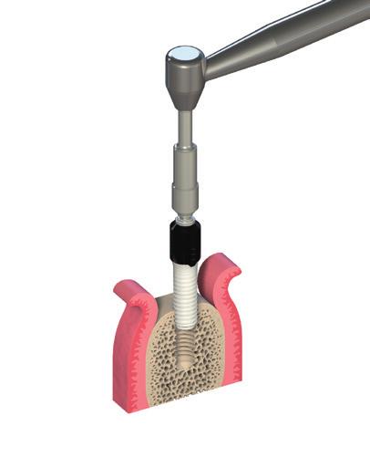4.4. Colocação do implante 1a 1b 1ª etapa Insira o implante Insira sempre o implante à profundidade correcta.