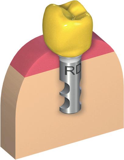 5.4 Criação e cimentação da restauração final 5.4.1 Procedimento laboratorial O implante cerâmico Straumann PURE Ceramic deve ser restaurado com restaurações inteiramente cerâmicas.