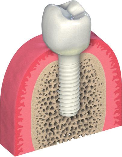 Planeamento pré-operatório ª etapa Desenho do coping ou coroa de contorno completo Straumann CARES A restauração é desenhada com o software (aprovado pela Straumann).