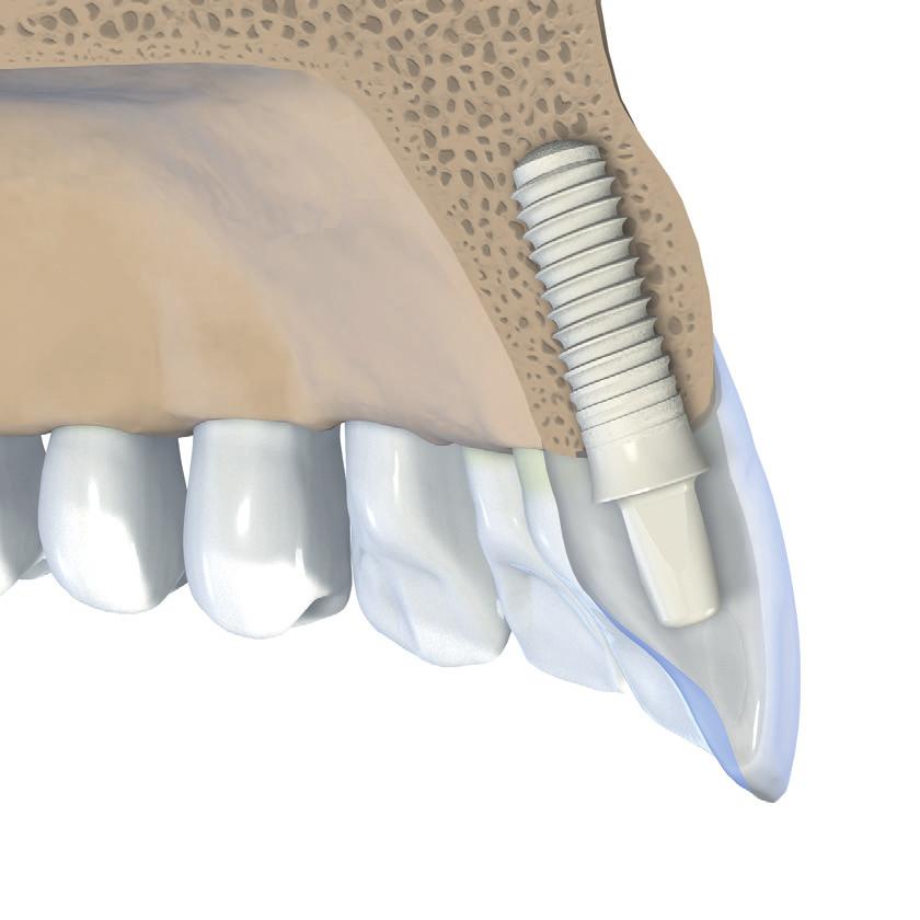 4,8 (RD) 4 8 4 16 3ª regra Deve prestar-se especial atenção ao posicionamento orofacial óptimo do implante, uma vez