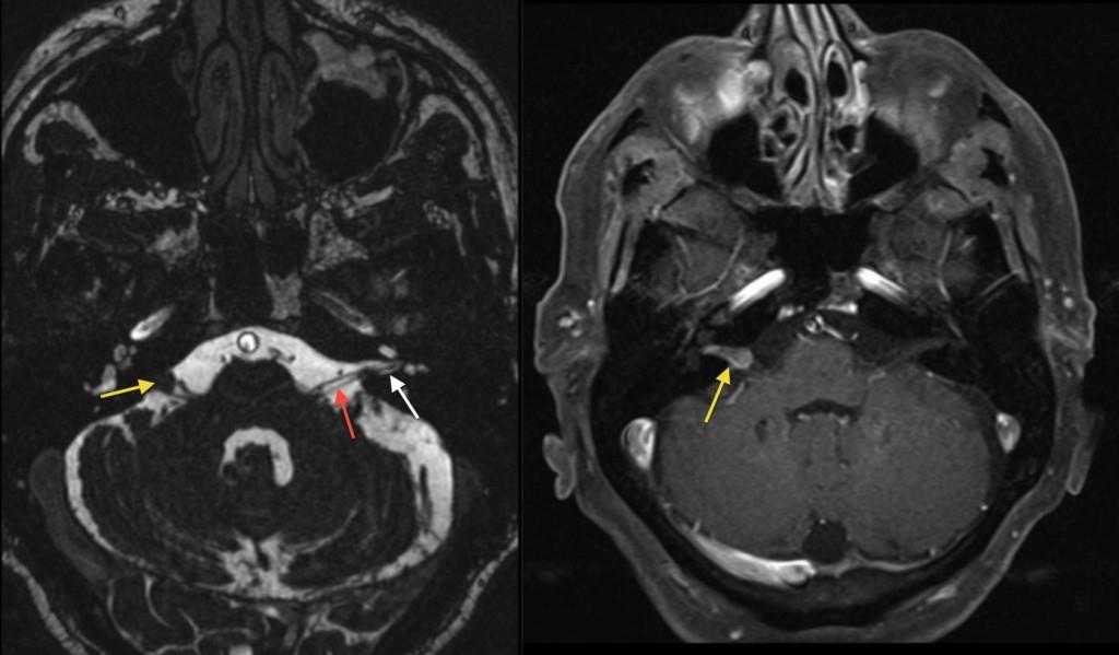 Neoplasia benigna