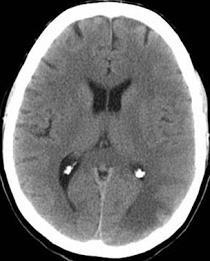 Infarto cerebral isquêmico adulto x criança CT de