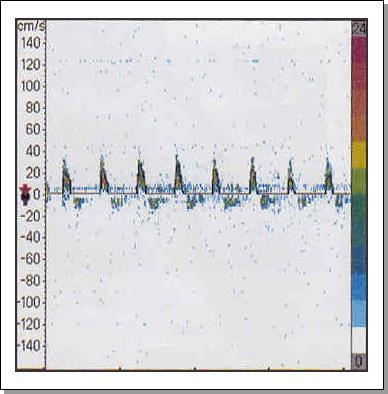 Doppler transcraniano Principais indicações: Doenças arteriais extracranianas Doenças arteriais intracranianas Embolia de origem cardíaca Doença arterial