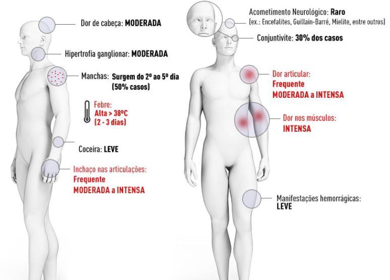 Febre Chikungunya: quadro clínico