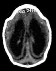 pigmentar focal; contraturas