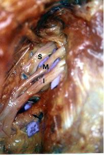 anterior abaixo da escápula Figura G - Após desinserção do tendão do músculo serrátil anterior, encontramos uma bainha contendo os