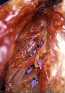 A artéria subclávia está antero-inferior ao tronco primário inferior. A veia subclávia está anterior à artéria.